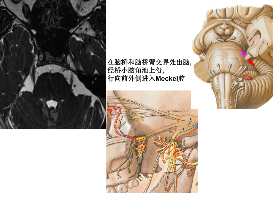 医学精品课件：颅内三叉神经鞘瘤.ppt_第3页