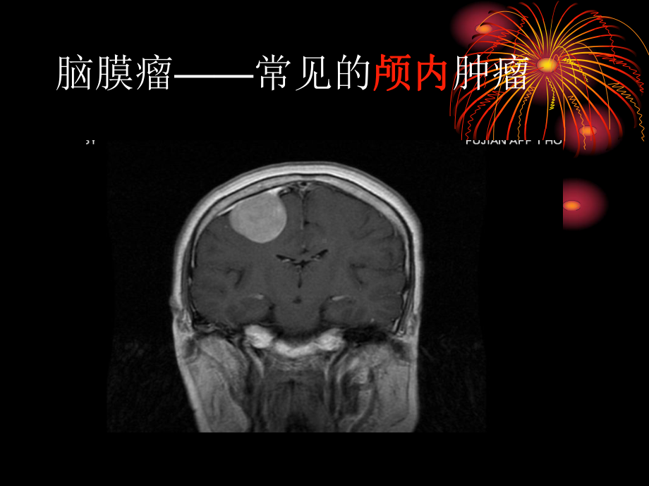 医学精品课件：脑膜瘤CTMRI的典型征象.ppt_第2页