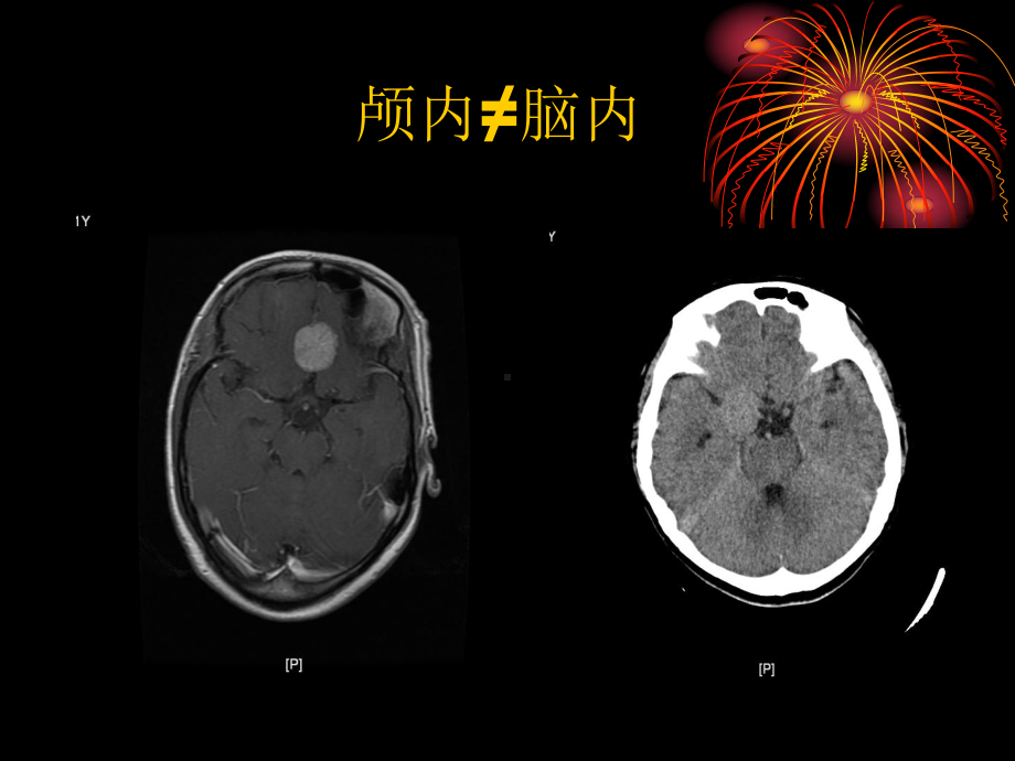 医学精品课件：脑膜瘤CTMRI的典型征象.ppt_第3页