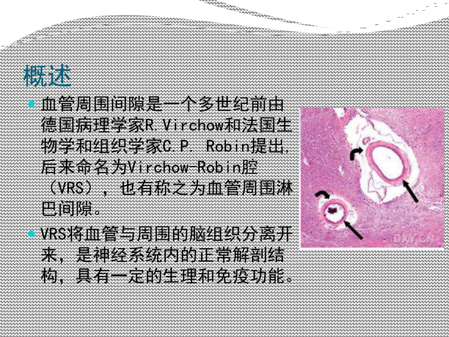 医学精品课件：脑血管(V-R)间隙的MRI诊断与鉴别诊断.ppt_第2页