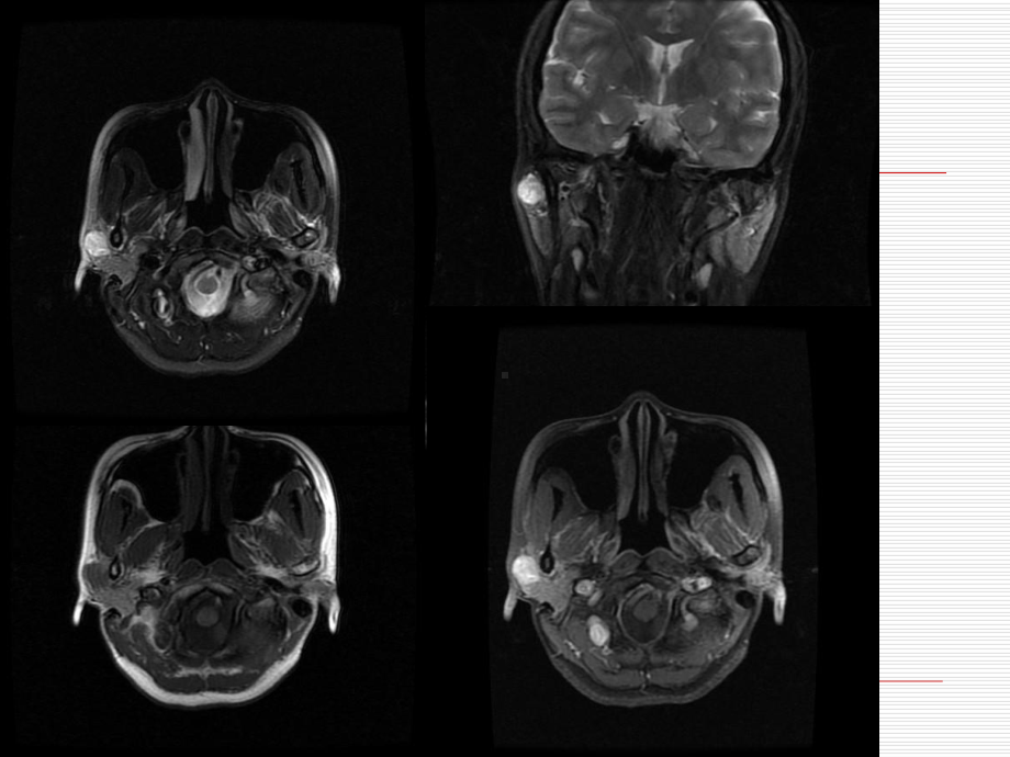医学精品课件：腮腺多形性腺瘤的MR诊断.ppt_第2页