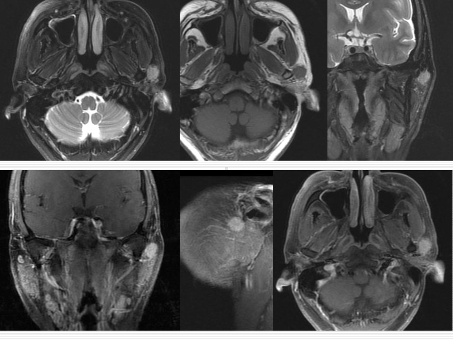 医学精品课件：腮腺多形性腺瘤的MR诊断.ppt_第3页