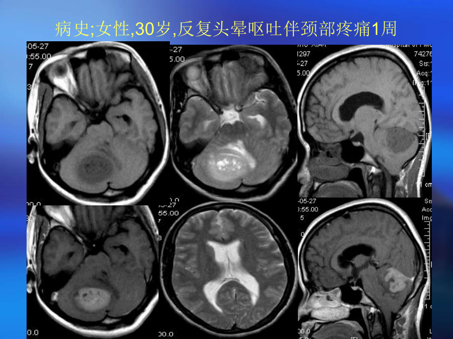 医学精品课件：髓母细胞瘤读片 (2).ppt_第2页