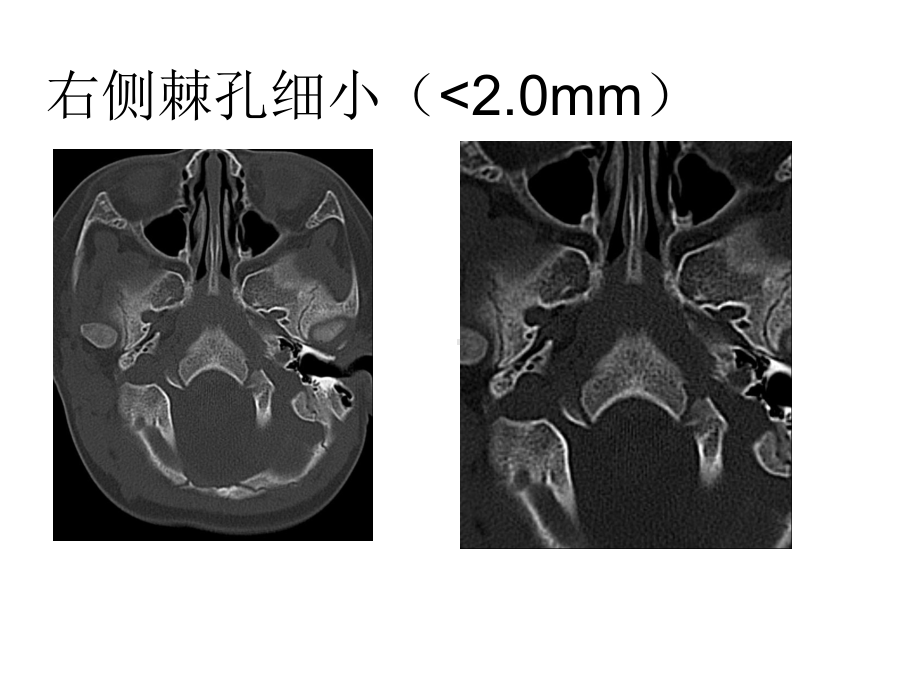 医学精品课件：外耳道闭锁.ppt_第2页