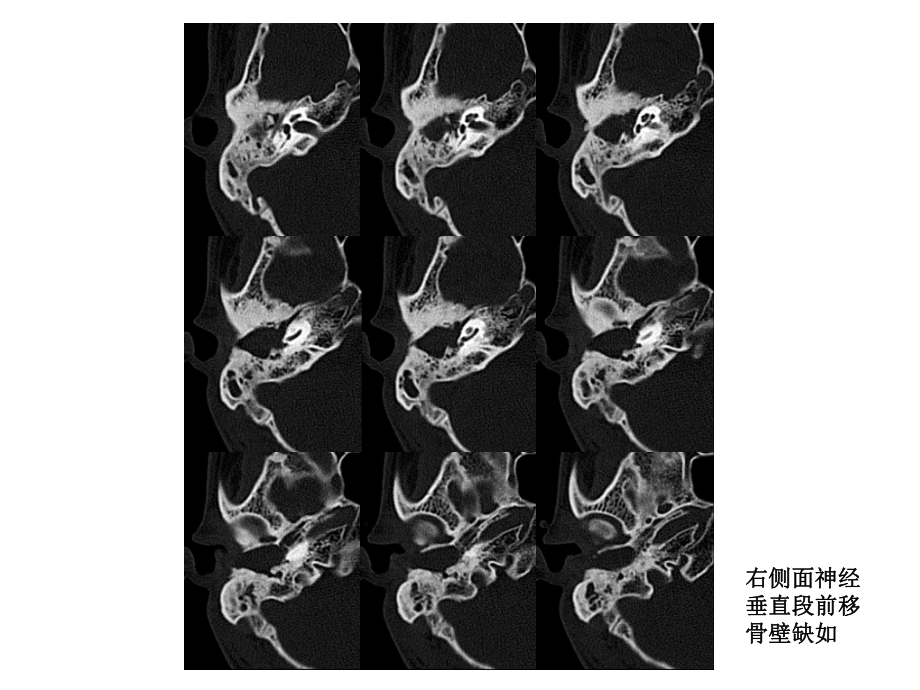 医学精品课件：外耳道闭锁.ppt_第3页