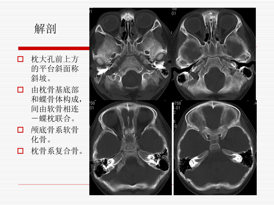 医学精品课件：斜坡病变的影像诊断.ppt_第2页