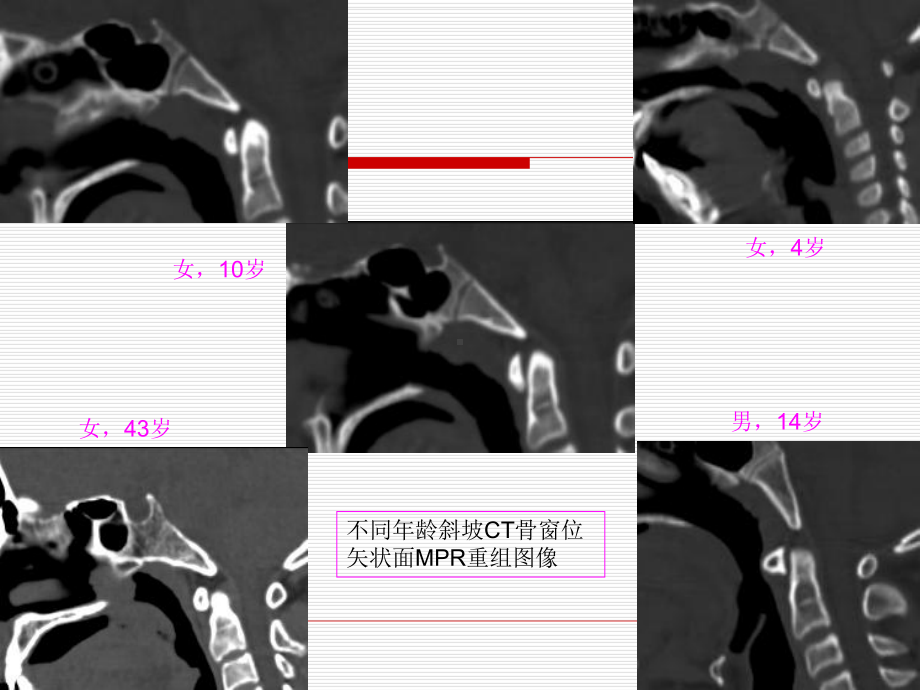 医学精品课件：斜坡病变的影像诊断.ppt_第3页