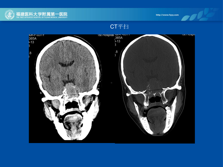 医学精品课件：斜坡-鞍区占位病例随访.ppt_第3页