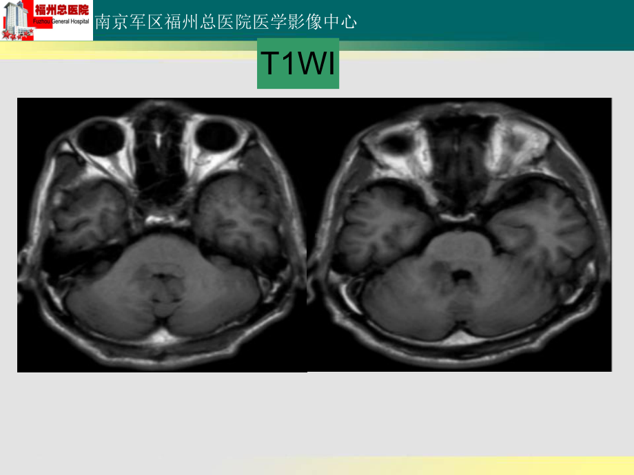 医学精品课件：小脑淋巴瘤读片.ppt_第3页