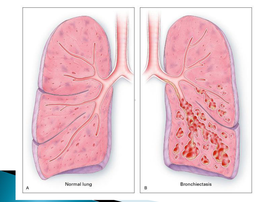 医学精品课件：支气管扩张.ppt_第3页