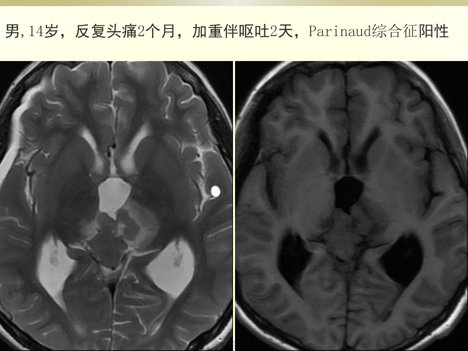 医学精品课件：松果体肿瘤.pptx_第3页