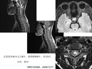 医学精品课件：视神经脊髓炎的MR诊断.ppt