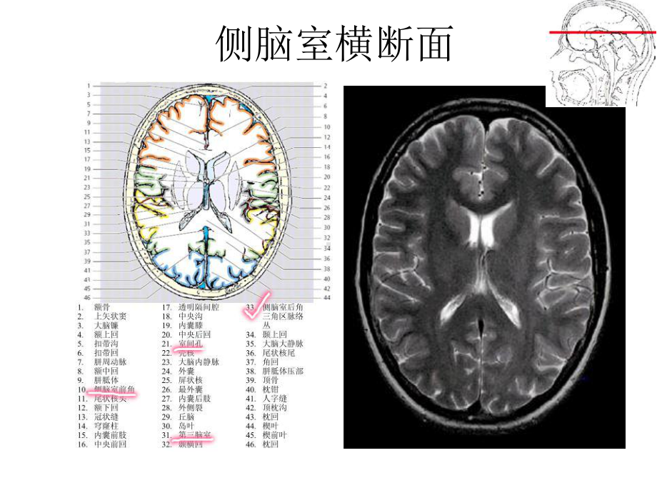 医学精品课件：室管膜瘤.ppt_第3页