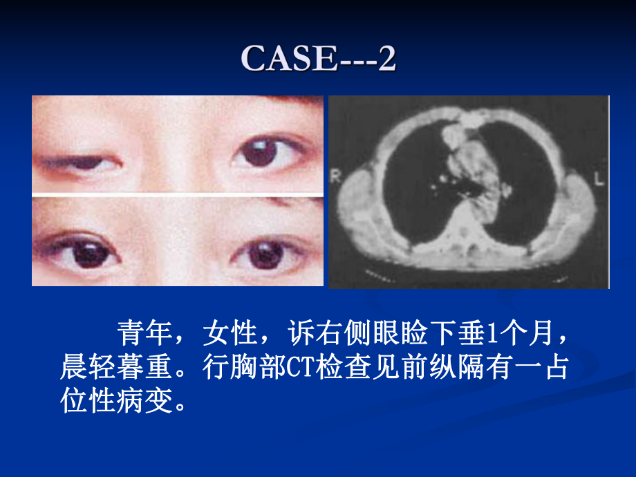 医学精品课件：肿瘤学纵隔肿瘤.ppt_第3页