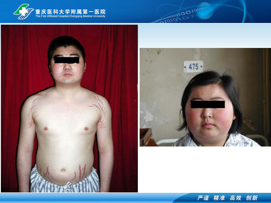 医学精品课件：01.2cushing syndrome .ppt_第2页