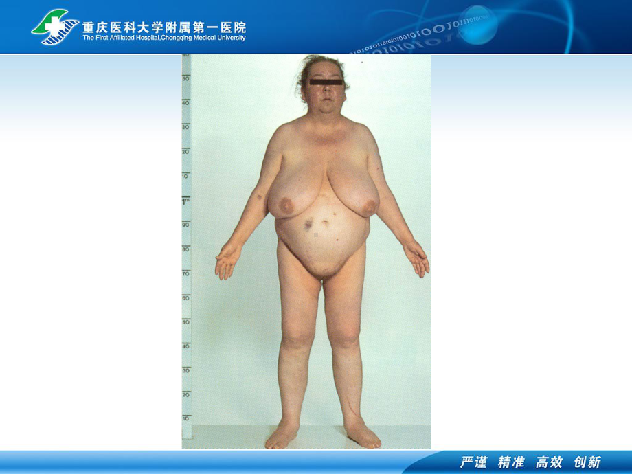 医学精品课件：01.2cushing syndrome .ppt_第3页