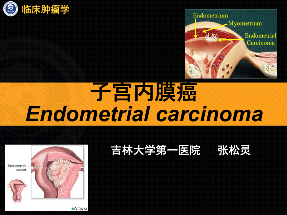 医学精品课件：子宫内膜癌.ppt_第1页