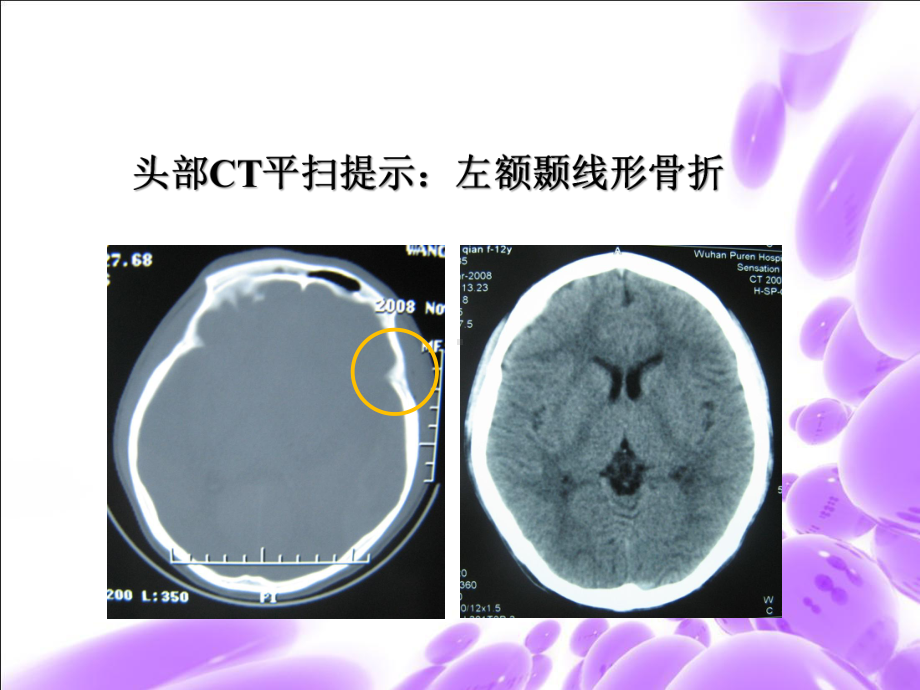 医学精品课件：颅内压增高-陈旭.ppt_第3页