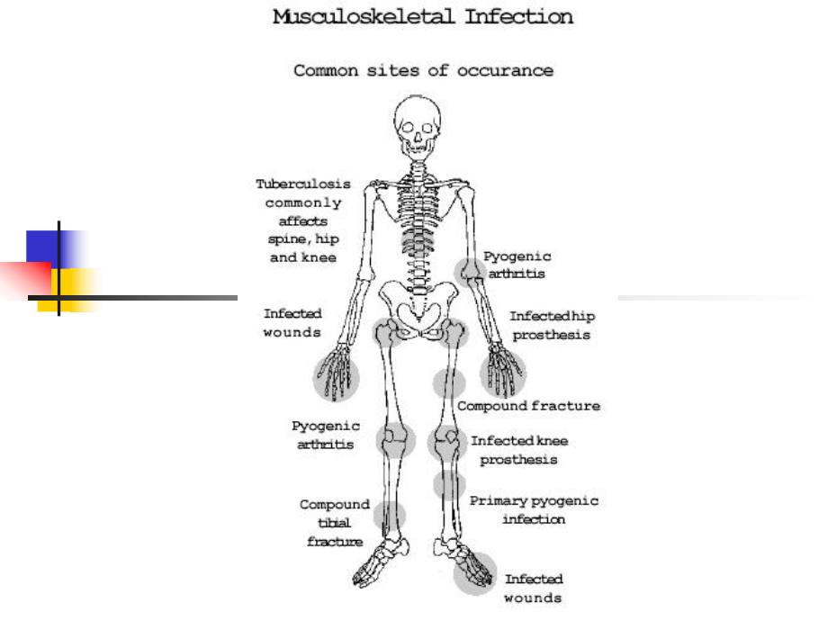 医学精品课件：骨与关节化脓性感染.ppt_第2页