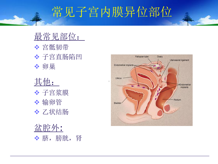 医学精品课件：6子宫内膜异位症.ppt_第3页