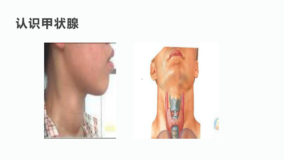 甲状腺结节蓝色甲状腺结节介绍教学课件.pptx_第3页