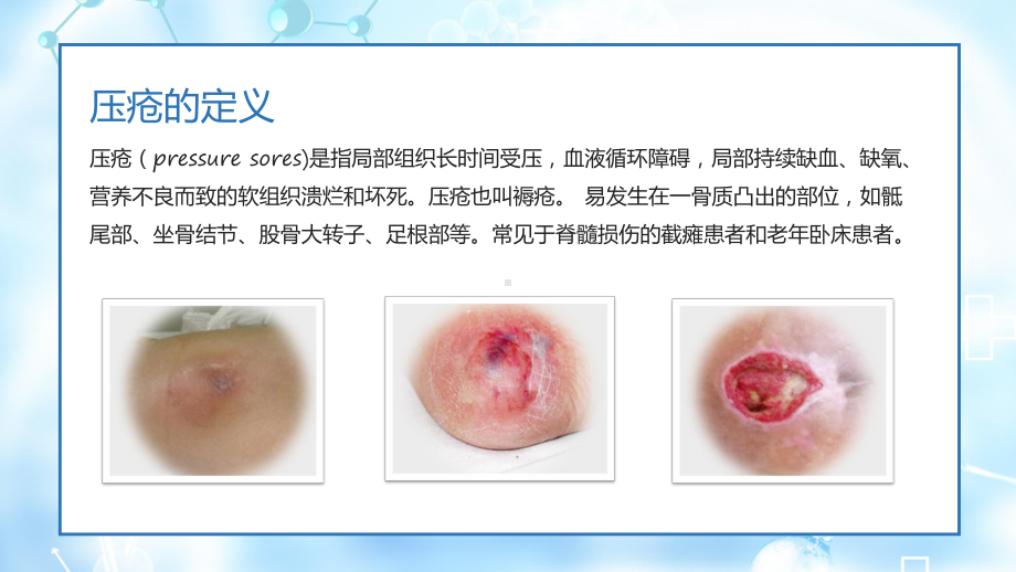 压疮的预防和护理辅导（ppt）.pptx_第3页