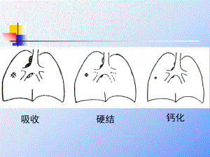 抗结核治疗.ppt