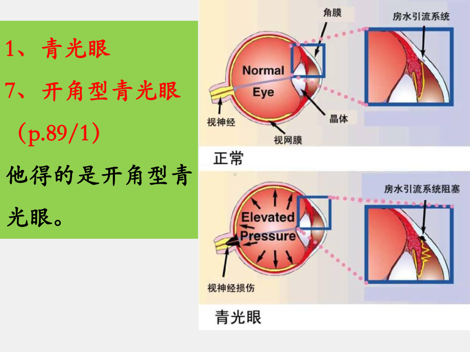 《医学汉语》课件第十课（青光眼）.pptx_第3页