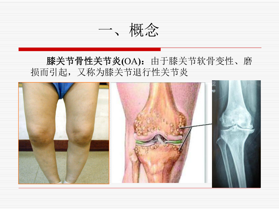 17膝关节骨性关节炎课件.ppt_第2页