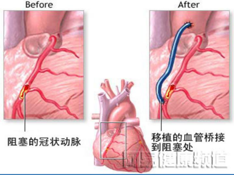 冠脉搭桥术后护理课件(同名11).ppt_第3页