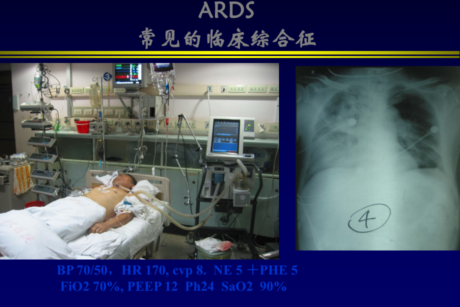 ARDS肺复张的临床实施培训课件.ppt_第2页