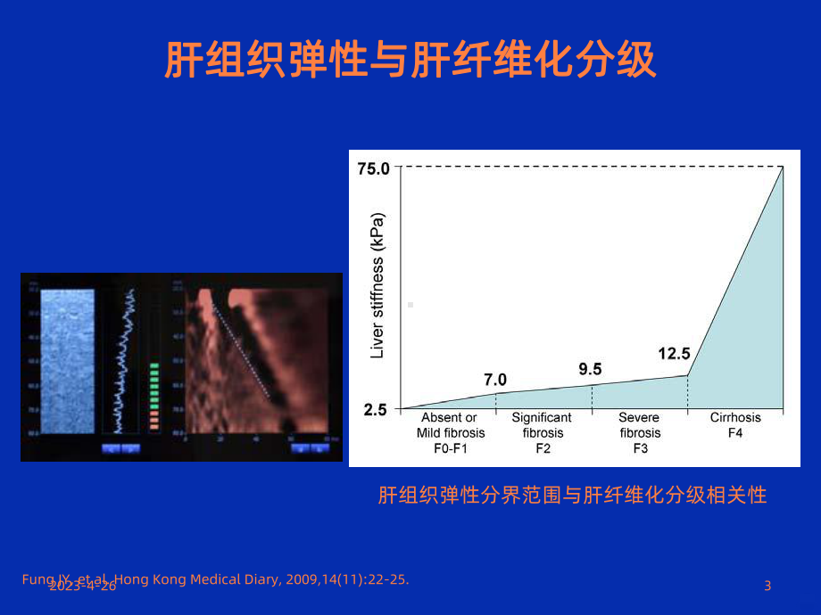 乙肝肝硬化并发症的处理课件.ppt_第3页