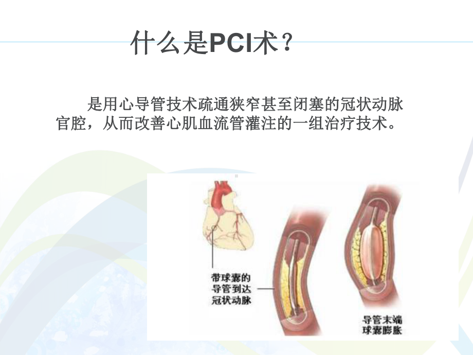 PCI术前术后的护理-课件.ppt_第2页