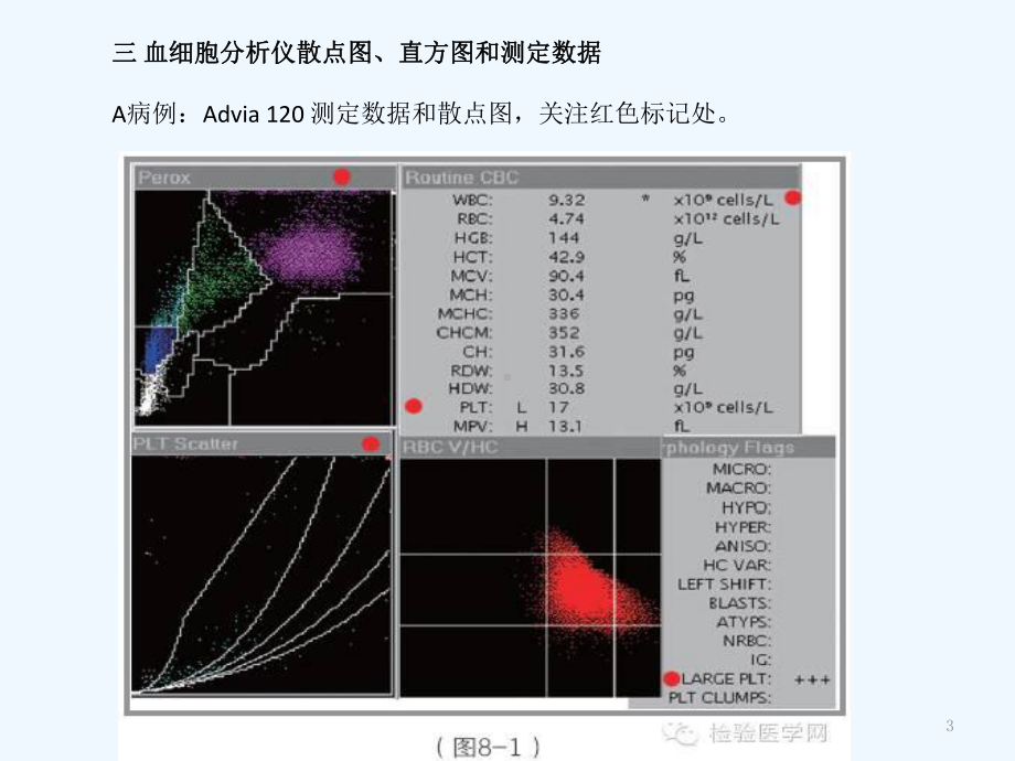 EDTA依赖性假性血小板减少-课件.ppt_第3页