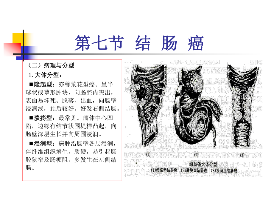 （教学讲解课件）-结肠癌.ppt_第3页