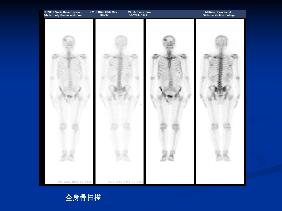 99mTc-MDP骨显像骨外异常显影课件.ppt_第3页