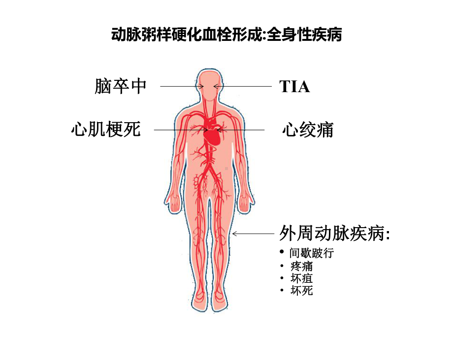 ASCVD时代总体心血管风险评估那点事儿-课件.ppt_第3页