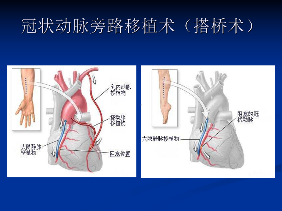 冠心病外科治疗（心血管外科）-课件.ppt_第2页