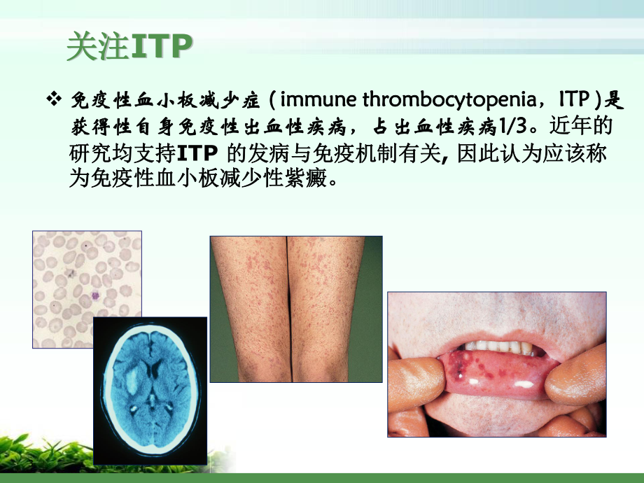 免疫性血小板减少性紫癜教学课件.ppt_第3页