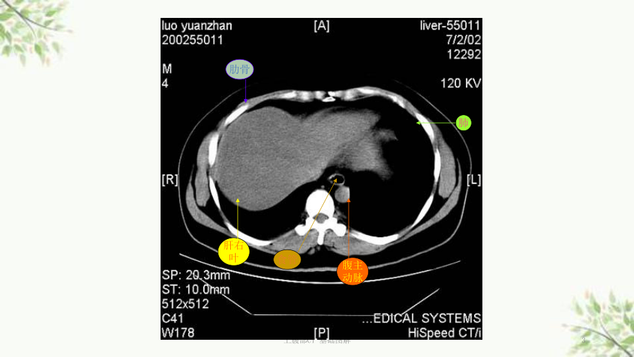 上腹部CT-基础图解课件.ppt_第3页