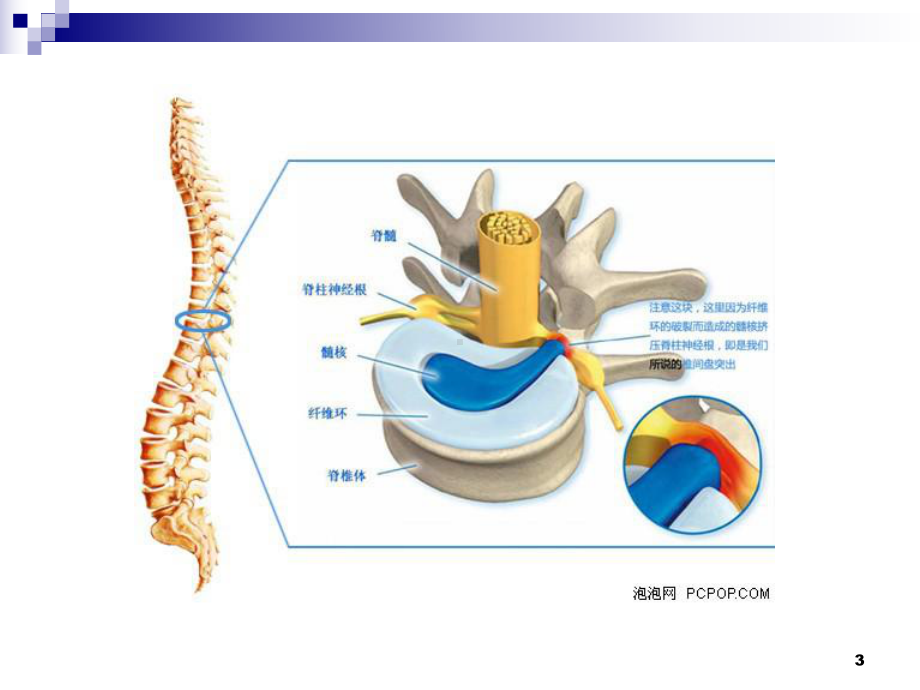 医学腰椎间盘突出的影像诊断专题培训课件.ppt_第3页