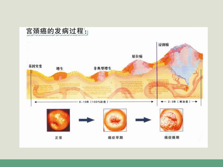 宫颈癌变CIN现象-课件.ppt_第3页