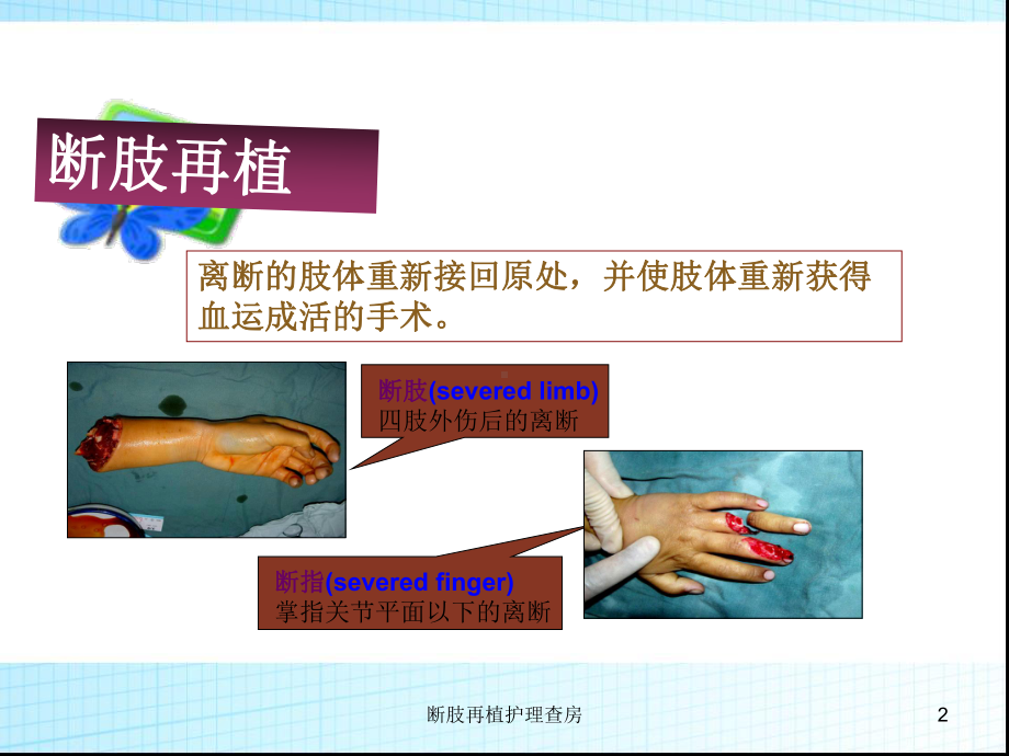 断肢再植护理查房培训课件.ppt_第2页