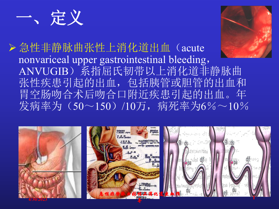 急性非静脉曲张性上消化道出血指导培训课件.ppt_第1页