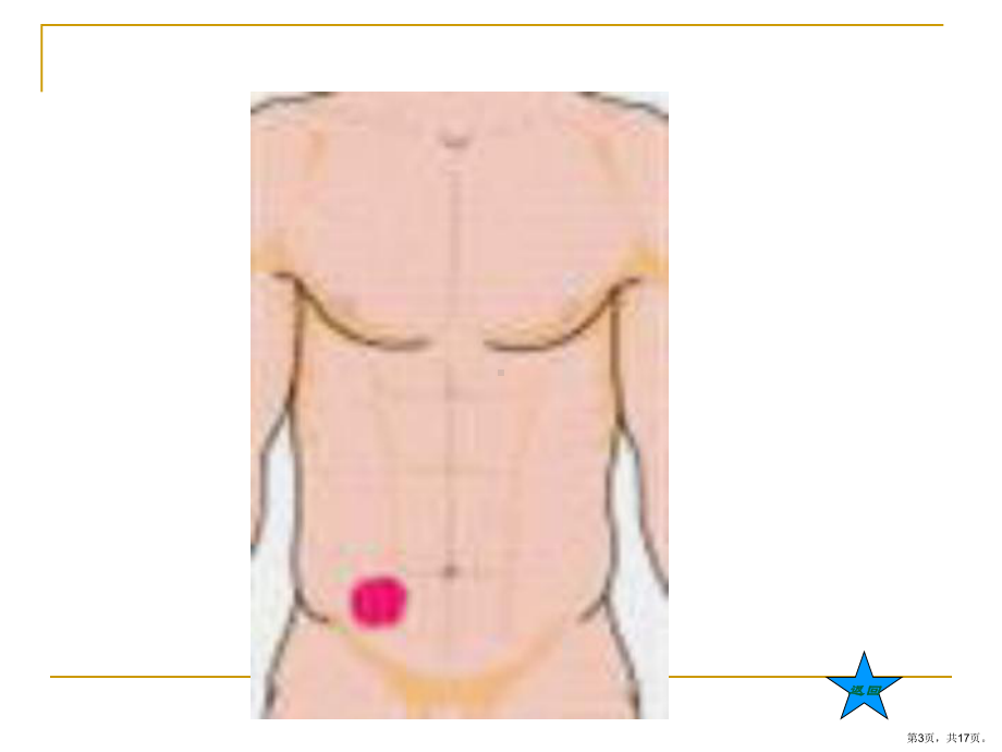 阑尾炎病人的护理PPT.pptx_第3页