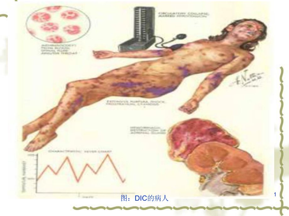 图DIC的病人课件.ppt_第1页