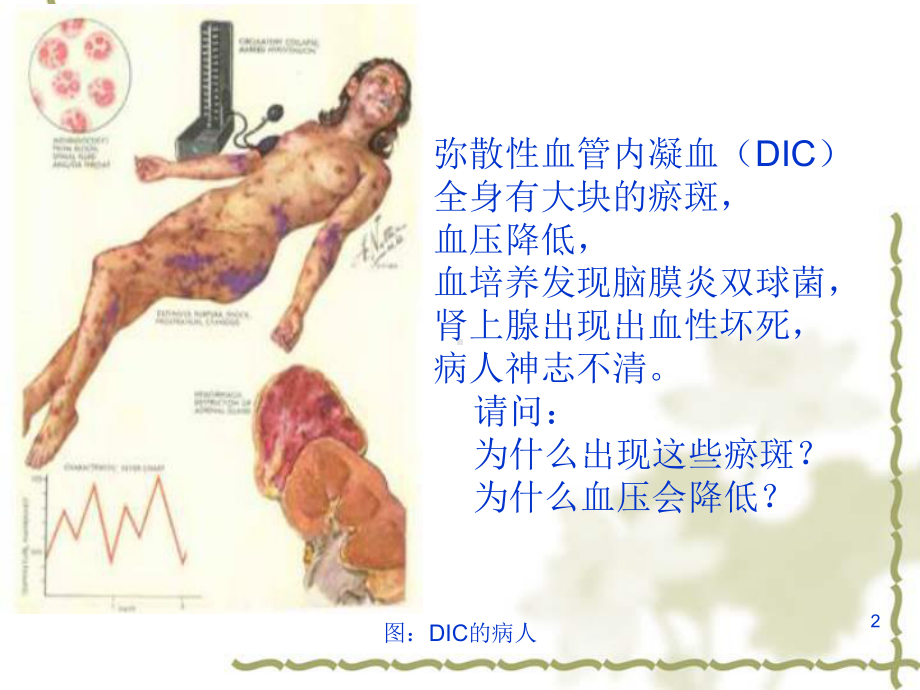 图DIC的病人课件.ppt_第2页