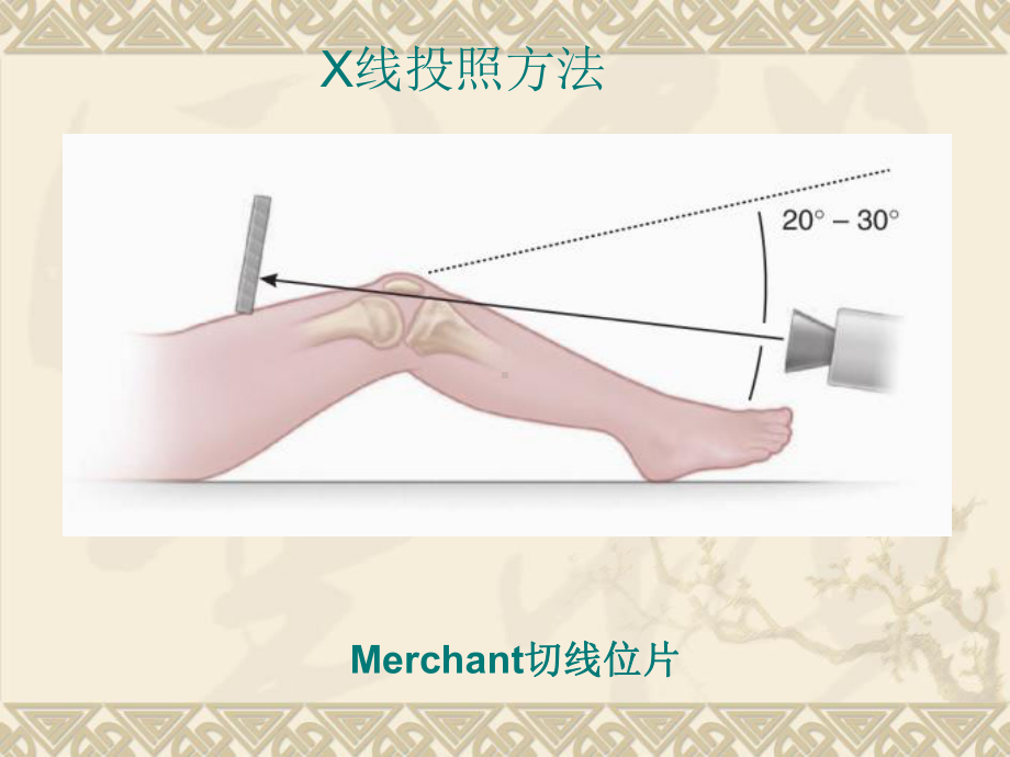 医学髌骨脱位精讲版培训课件.ppt_第3页