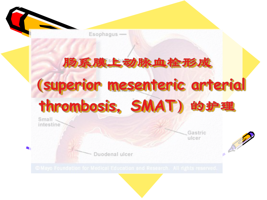 医学课件-肠系膜上动脉血栓形成的护理教学课件.ppt_第1页