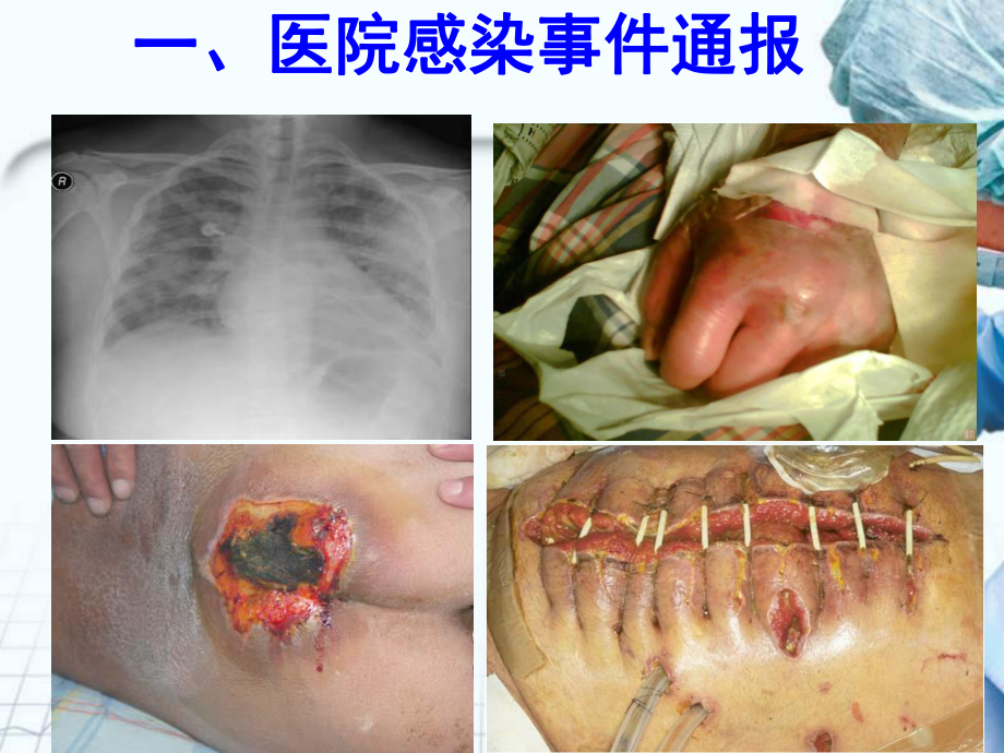 医学近年国内医院感染案例启示及暴发报告专题课件.ppt_第3页